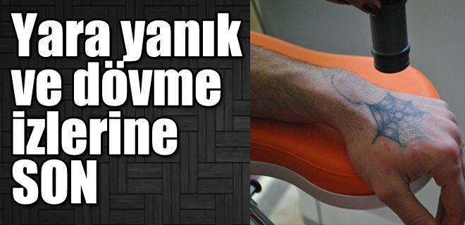 Yara ve yanık izlerine son